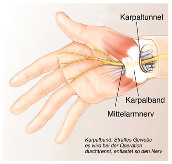 Darstellung des Karpaltunnels in der Hand